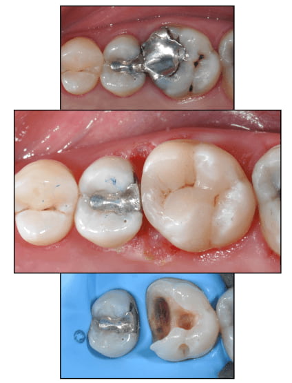 Dentistico - amalgán
