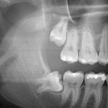 Retinovaný zub moudrosti – neprořezaný s nevhodnou polohou, řešením je včasná extrakce