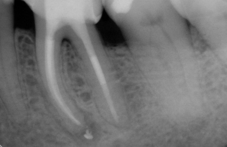 Zub s nedokonale ošetřenými kořenovými kanálky - stav po