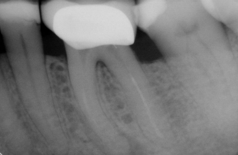 Zub s nedokonale ošetřenými kořenovými kanálky - stav před