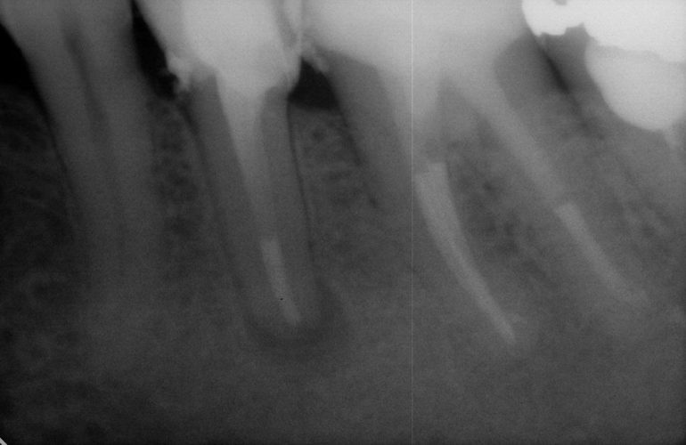 Zuby s nedokonale ošetřenými kořenovými kanálky - stav po