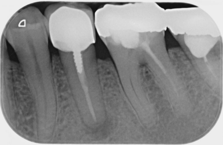 Zuby s nedokonale ošetřenými kořenovými kanálky - stav před